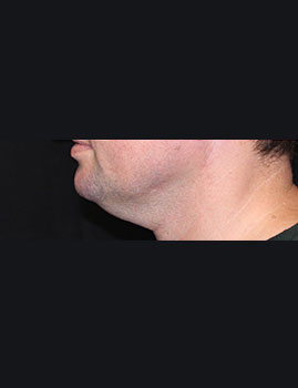CoolSculpting Chin After