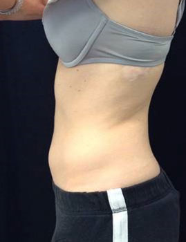 CoolSculpting Stomach After